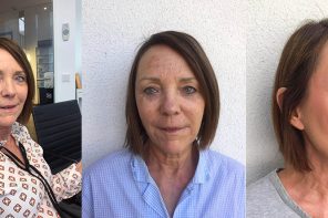 Mesotherapie für die Gesichtshaut im Test mit Vorher- nachher Bildern