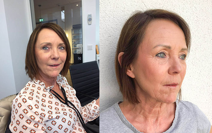 Hyaluron Kapseln Vorher Nachher Bilder